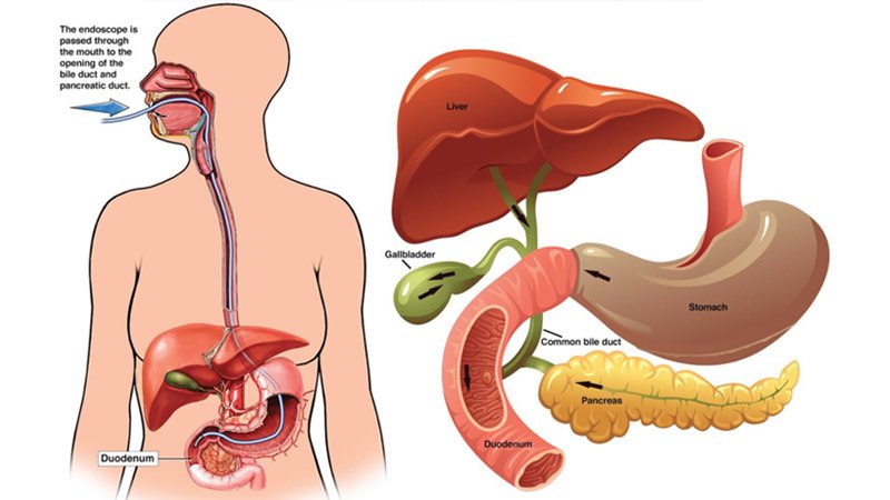ERCP